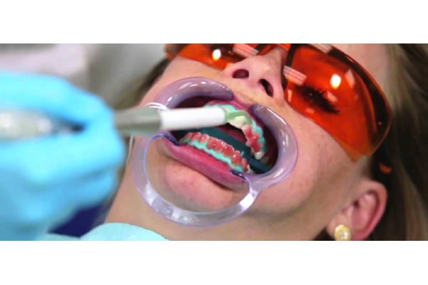 Отбеливание зубов одной челюсти