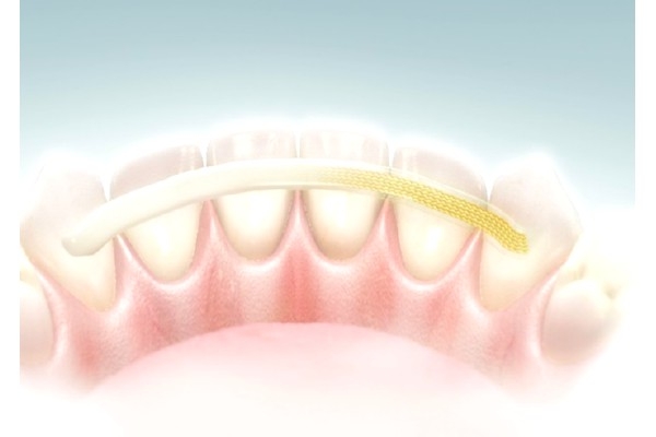 Стекловолоконное шинирование зубов 