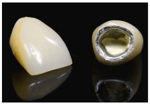 Металлокерамика коронка на передний зуб