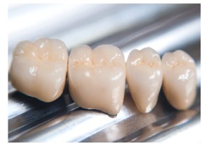Коронка зуба металлокерамическая 