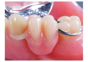 Протезирование 1 зуба