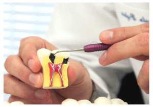Лечение пульпита 1-го канального зуба