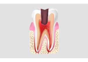 Лечение пульпита 2-х канального зуба