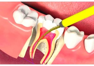 Лечение пульпита 3-х канального зуба