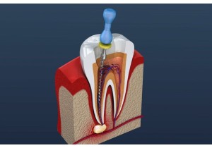 Лечение пульпита 4-х канального зуба