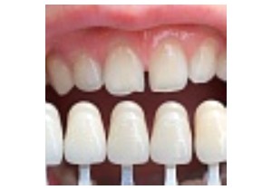 Наращивание коронковой части зуба (при полном отсутствии)