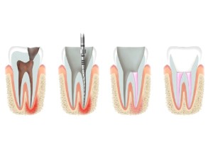Пломбировка каналов (2-х канальный зуб)