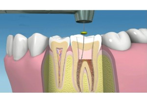 Пломбировка каналов (4-х канальный зуб)