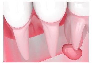 Лечение кисты зуба без удаления