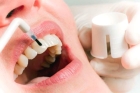 Лечение эмали зубов