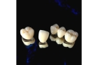 Металлокерамическая коронка на зуб