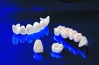 Керамическая накладка на зуб