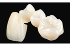 Коронка керамическая на передние зубы