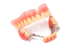 Бюгельное протезирование зубов