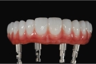 Протезирование зубов циркониевой коронкой