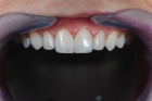 Частичная реставрация зуба  
