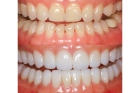 Эстетическая реставрация зубов    