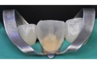 Композитная реставрация зуба 