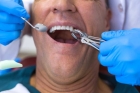 Удаление трехкорневого зуба