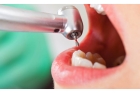 Лечение глубокого кариеса (при сохранении менее 60% зуба)