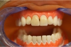 Реставрация зуба композитом