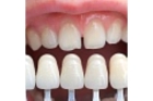 Наращивание коронковой части зуба (при полном отсутствии)