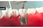 Обработка каналов (1 канальный зуб)