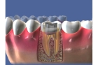 Пломбировка каналов (1 канальный зуб)