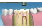 Пломбировка каналов (4-х канальный зуб)